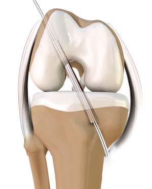 Anterior Cruciate Ligament (ACL) Tear/Reconstruction