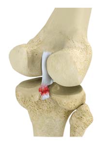 Posterior Cruciate Ligament (PCL) Tear/Reconstruction