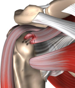 The Anterior cruciate ligament