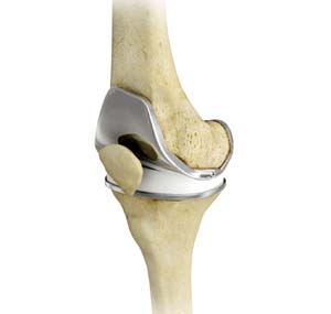 Knee Replacement (Partial and Total Knee Replacement)